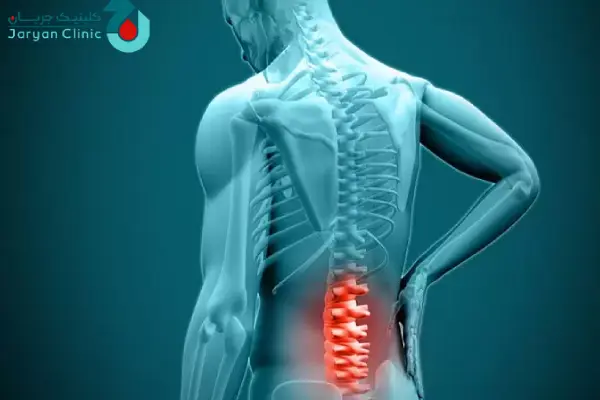 مزایای اوزون تراپی دیسک کمر