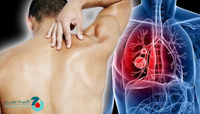 آیا کمر درد نشانه سرطان است؟