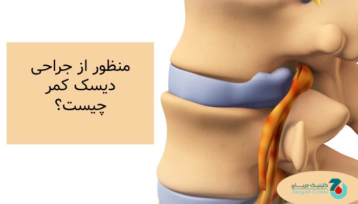 منظور از جراحی دیسک کمر چیست؟