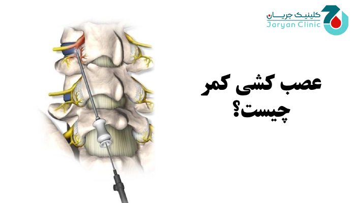 عصب کشی کمر چیست؟