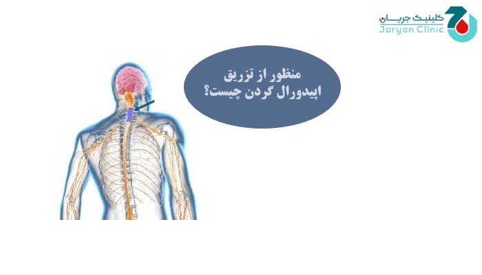 تزریق اپیدورال گردن چیست؟