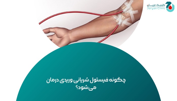 درمان فیستول شریانی وریدی