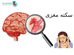 سکته مغزی