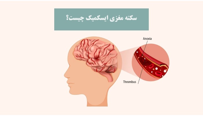 سکته مغزی ایسکمیک چیست؟