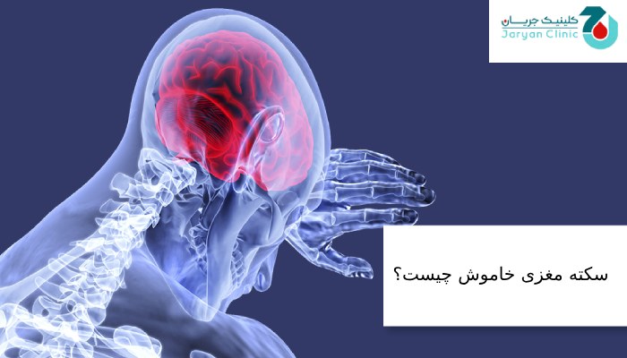 سکته مغزی خاموش چیست؟