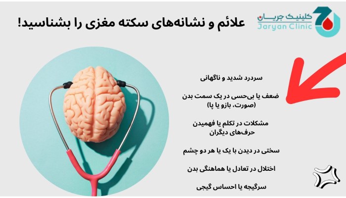 علائم سکته مغزی