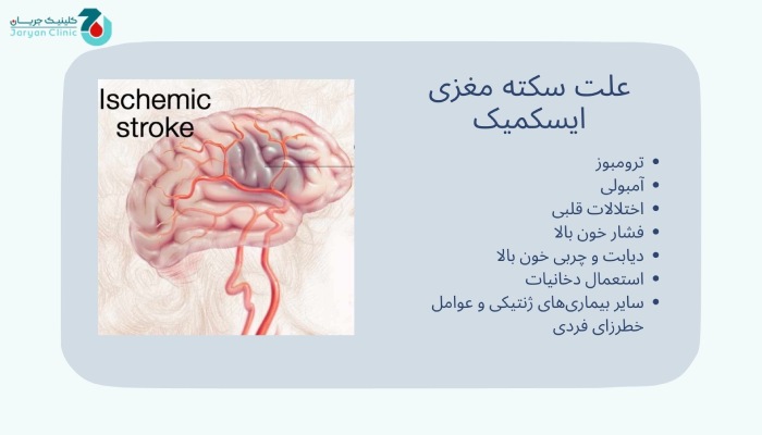 علت سکته مغزی ایسکمیک