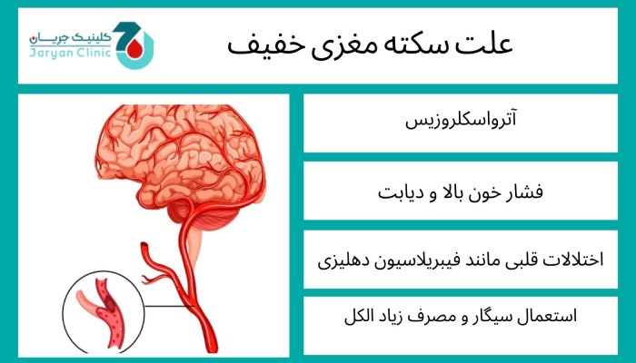 علت سکته مغزی خفیف
