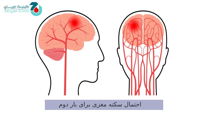 احتمال سکته مغزی برای بار دوم