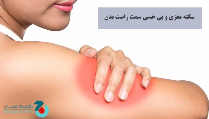 ارتباط سکته مغزی و بی حسی سمت راست بدن