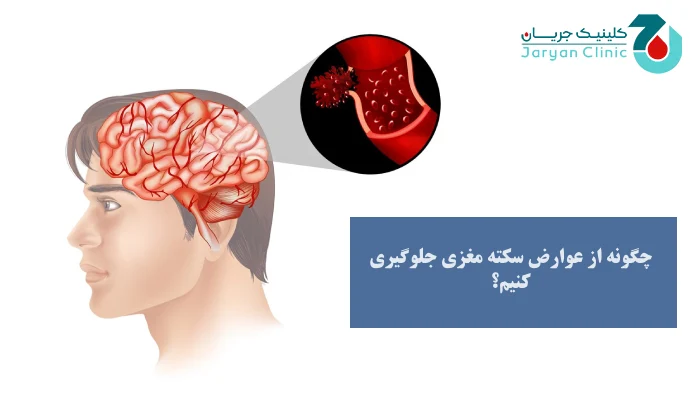 جلوگیری از عوارض سکته مغزی