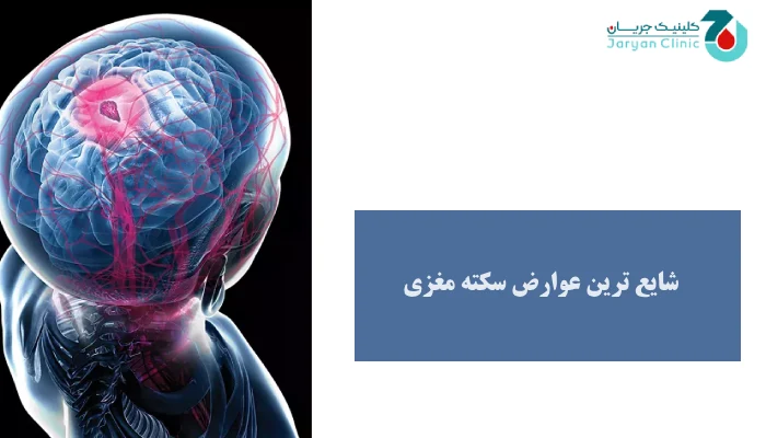 شایع ترین عوارض سکته مغزی