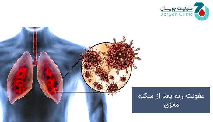علت عفونت ریه بعد از سکته مغزی