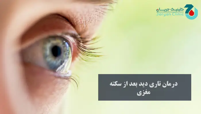 درمان تاری دید بعد از سکته مغزی