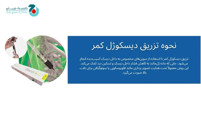 نحوه تزریق دیسکوژل کمر