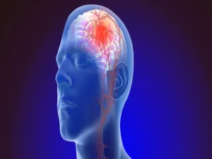آنژیوپلاستی مغز
