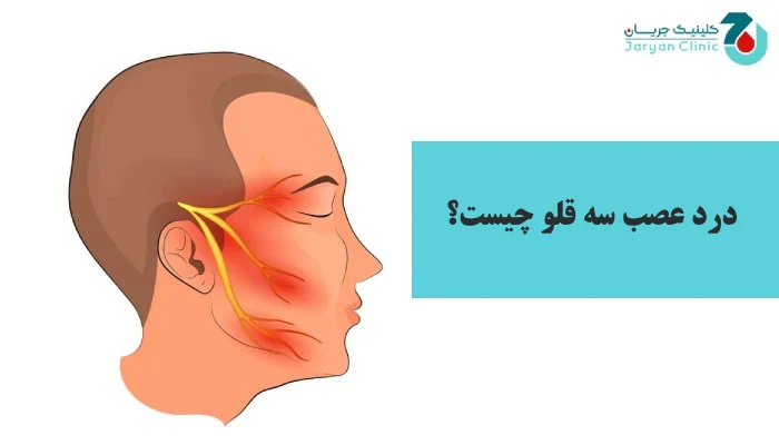 درد عصب سه‌ قلو چیست؟
