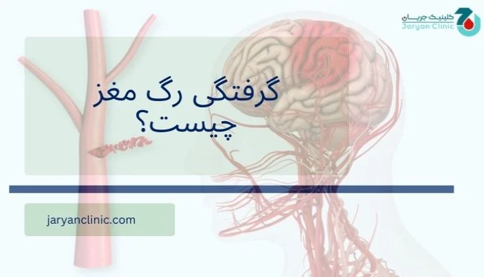 گرفتگی رگ مغز چیست؟
