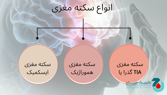 انواع سکته مغزی چیست