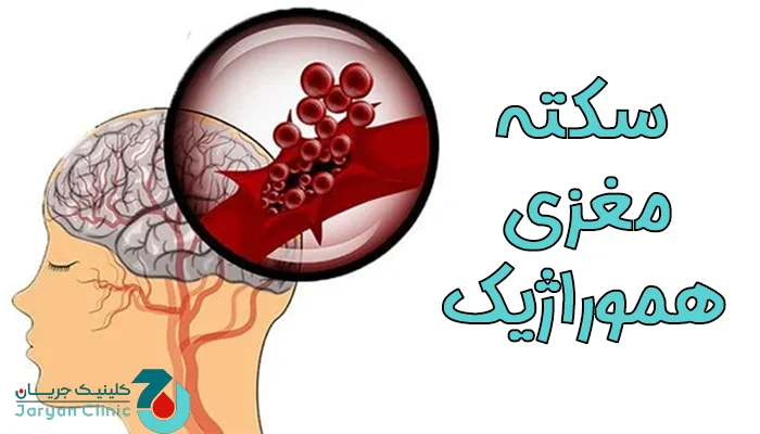 سکته مغزی هموراژیک