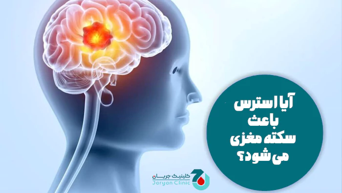 آیا استرس باعث سکته مغزی می‌شود؟