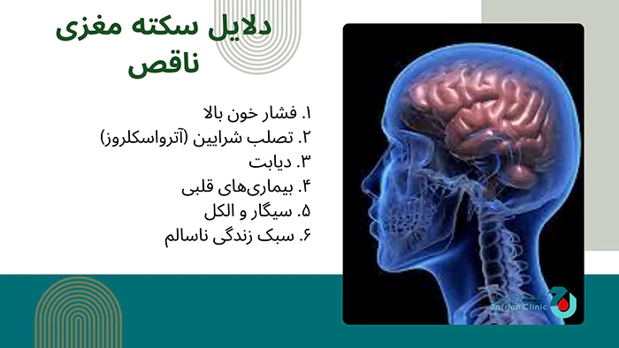 دلایل سکته مغزی ناقص