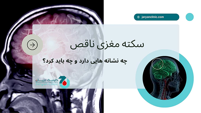 سکته مغری ناقص چیست