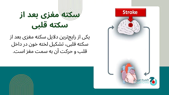 سکته مغزی پس از سکته قلبی