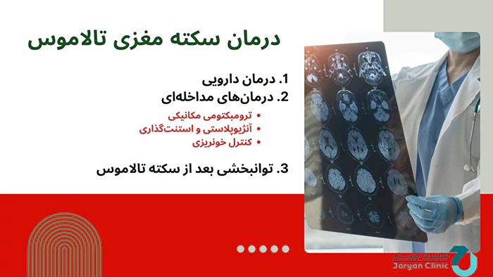 درمان سکته مغزی تالاموس