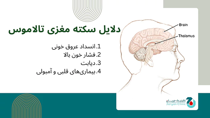 دلایل سکته مغزی تالاموس