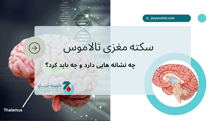 سکته تالاموس