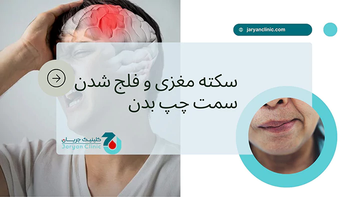 سکته مغزی و بی حس شدن سمت چپ بدن