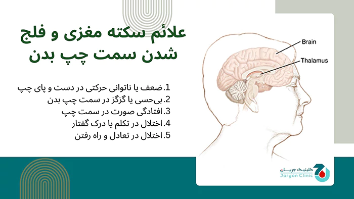 علائم سکته مغزی و فلج شدن سمت چپ بدن
