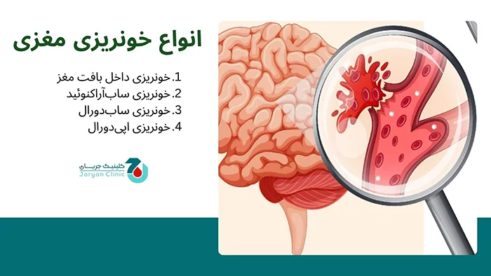 انواع خونریزی مغزی