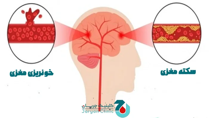 تفاوت خونریزی مغزی با سکته مغزی