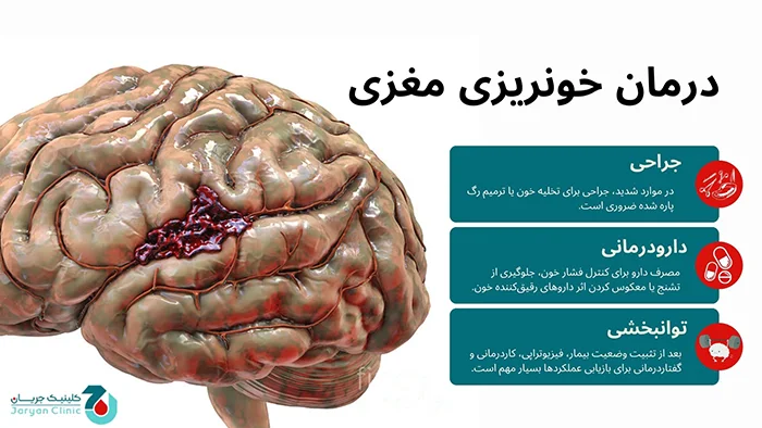 درمان خونریزی مغزی
