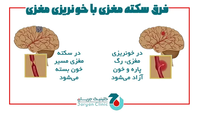 فرق سکته با خونریزی مغزی